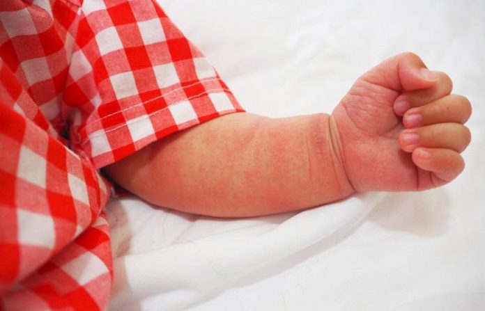 Atopik dermatit (Egzama) bebeklik döneminde sık görülüyor